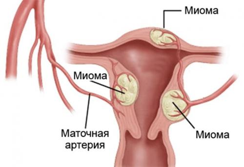 Почему нельзя пить много воды при месячных. Причины сильного маточного кровотечени я при месячных