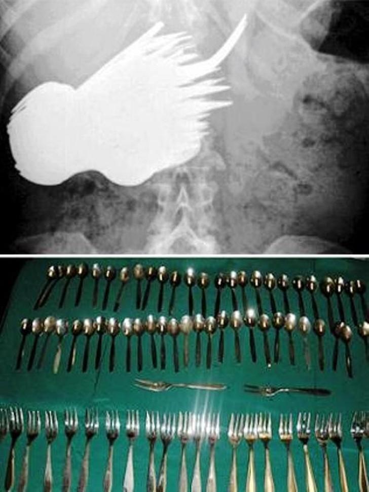 Фотография: Самые невероятные предметы, которые были найдены в человеческом теле №13 - BigPicture.ru