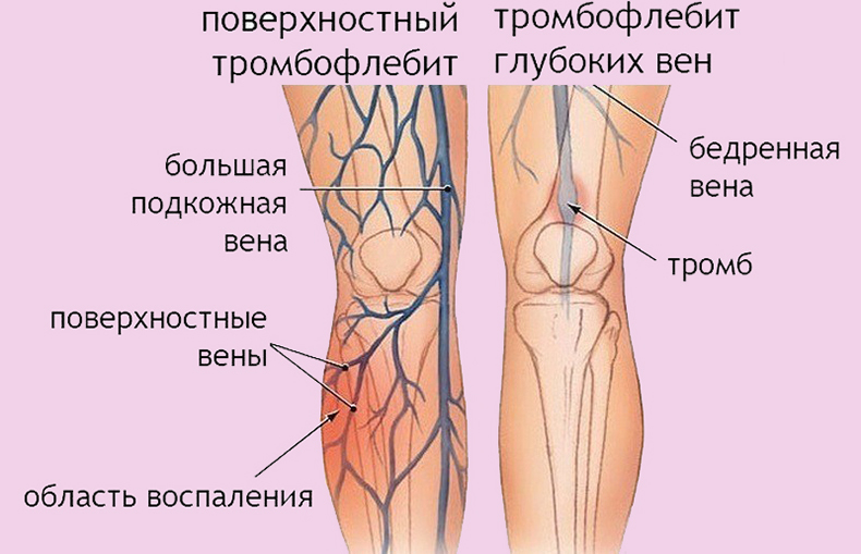 Внимание! Первые симптомы тромба в ноге Внимание! Первые симптомы тромба в ноге