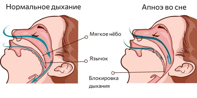 Дыхательные пути во время сна сужаются, поэтому возникает апноэ Дыхательные пути во время сна сужаются, поэтому возникает апноэ