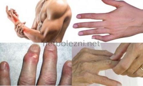 Почему кисть руки часто хрустит и как с этим бороться 01