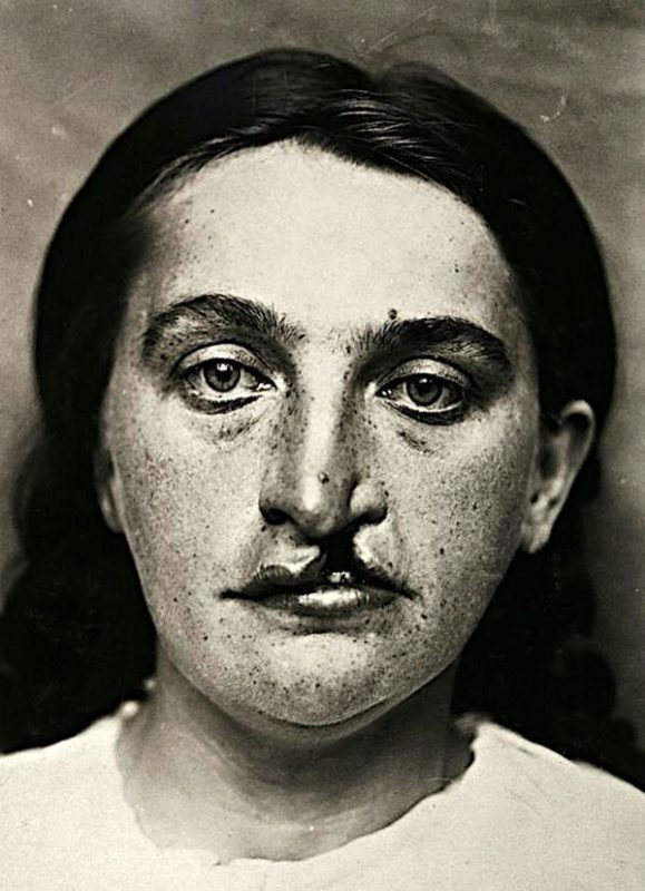 Фотография: Портреты боли: поразительные фотографии пациентов из XIX века, страдающих от тяжких болезней №11 - BigPicture.ru