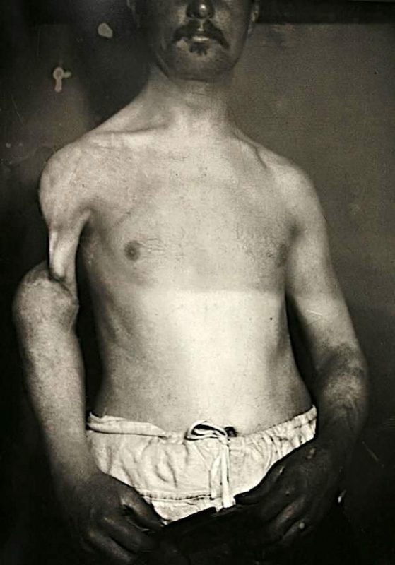 Фотография: Портреты боли: поразительные фотографии пациентов из XIX века, страдающих от тяжких болезней №6 - BigPicture.ru