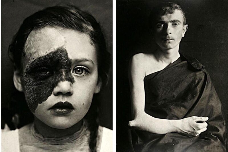 Фотография: Портреты боли: поразительные фотографии пациентов из XIX века, страдающих от тяжких болезней №1 - BigPicture.ru