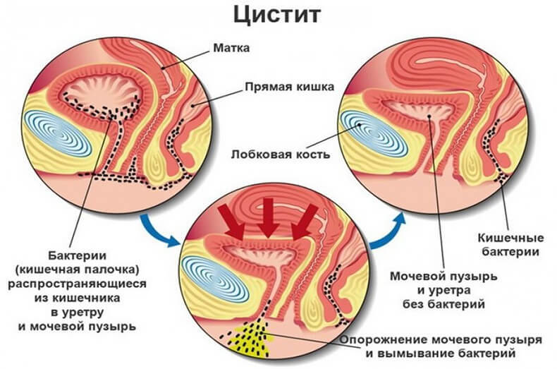 Доктор Евдокименко: Как вылечить цистит за 1 день&nbsp;– без таблеток и антибиотиков