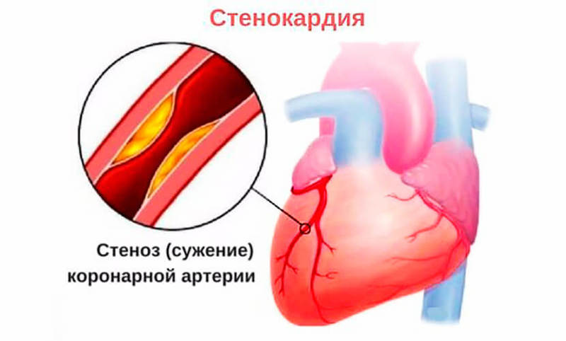 Грудная жаба: Первая помощь при приступе стенокардии Грудная жаба: Первая помощь при приступе стенокардии